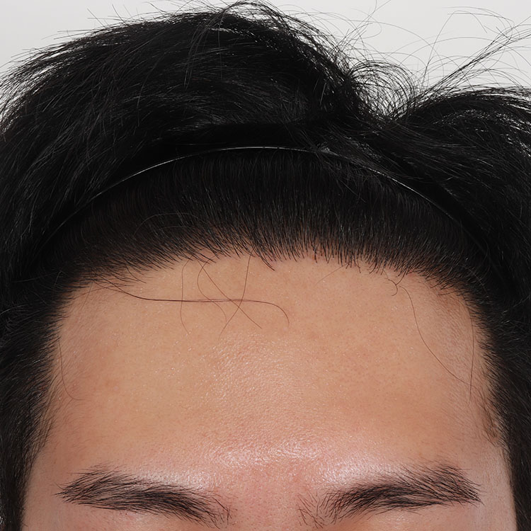 치료 후