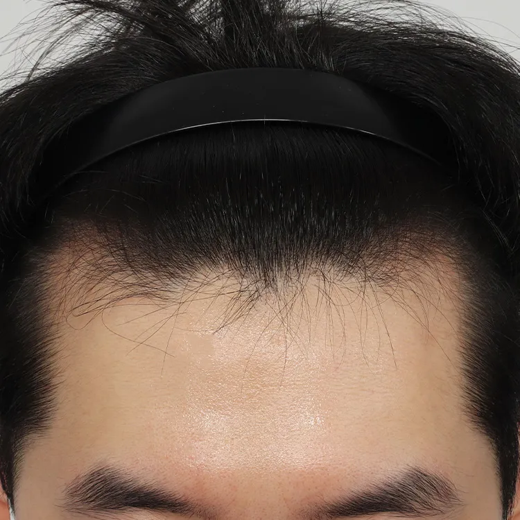 치료 후